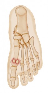 استخوان سزموئید موجود در پا (نمای کف پا)