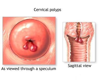 cervical polyps