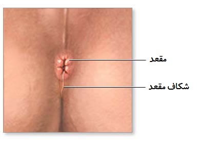 پارگی مقعد