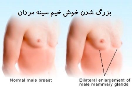 gynecomastia