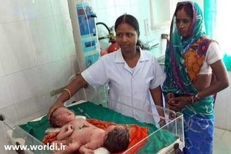 دوقلوهای عجیب با یک اندام جنسی مشترک بر روی یک بدن!