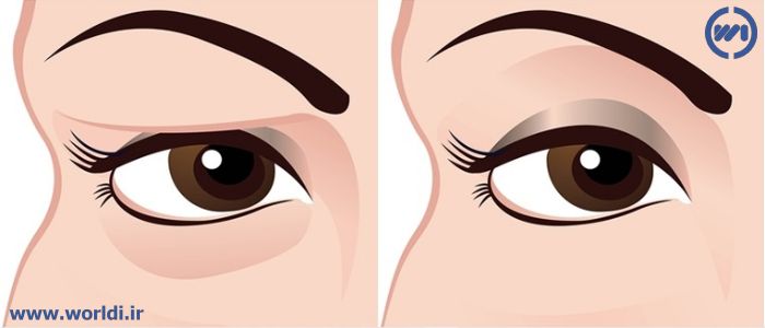 عمل جراحی زیباسازی پلک