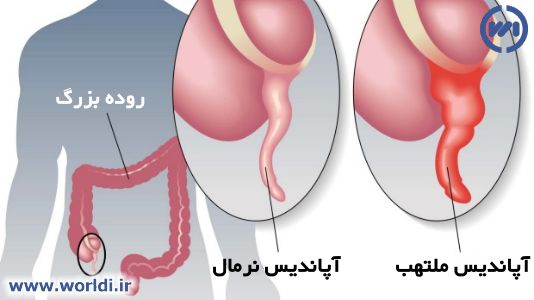بیماری آپاندیسیت