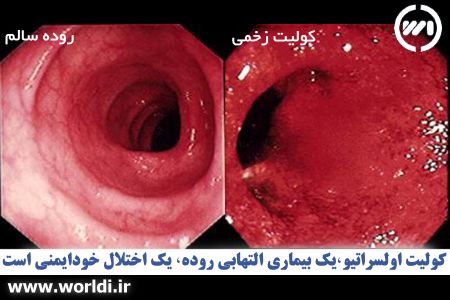 کولیت اولسراتیو