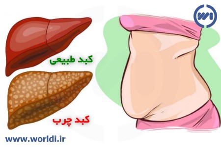 کبد چرب