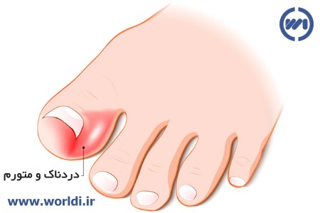 ناخن فرو رفته در گوشت پا