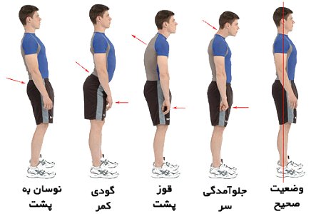 درمان قوز کمر