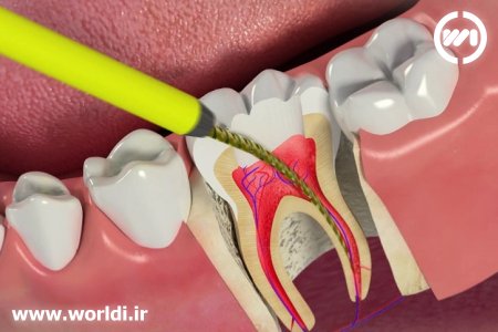 مراقبت های پس از درمان ریشه
