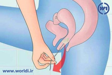 گذاشتن سیر در واژن