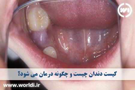کیست دندان چیست؟