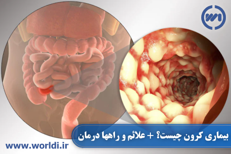 همه چیز در مورد بیماری کرون